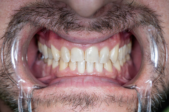 Teeth of a man. The mouth is wide open with retractors, the teeth are visible up close.