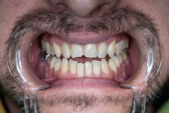Teeth of a man. The mouth is wide open with retractors, the teeth are visible up close.