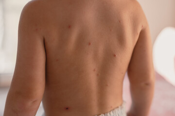 Little boy with chickenpox at home. Childhood rash. Little child with allergies, atopic dermatitis...