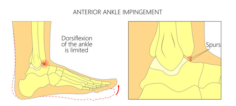 Anterior ankle impingement