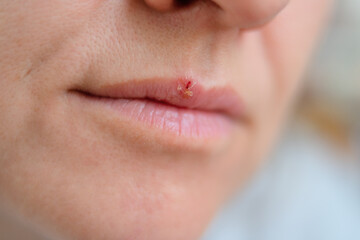 Macro of female lips with visible cold sore. Herpes infection during illness and cold. Concept of self care, treatment, and health protection.