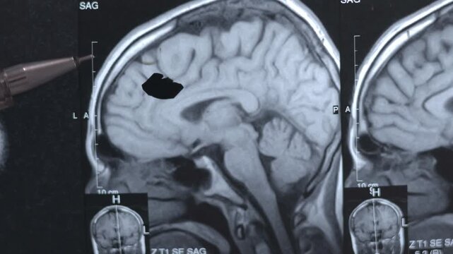 A doctor examines an X-ray of a human brain. Treatment head diseases. Close up.
