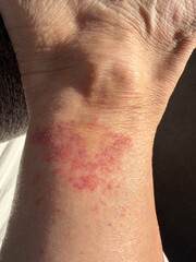 Vasculitis blood vessel inflammation on the lower leg above the ankle