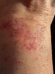 Vasculitis blood vessel inflammation on the lower leg above the ankle