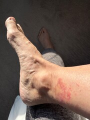 Vasculitis blood vessel inflammation on the lower leg above the ankle