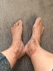Vasculitis blood vessel inflammation on the lower leg above the ankle