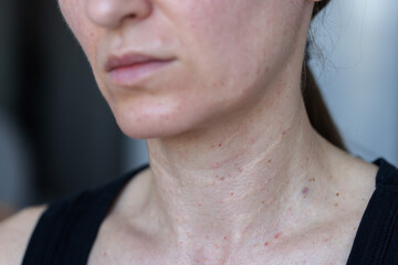 Female neck after beauty injections. Biorevitalization concept.