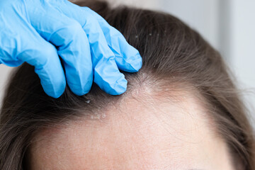 An appointment with a dermatologist. Woman has dermatitis on her scalp.