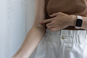 Traces on the hand after taking a vein blood test. Closeup.
