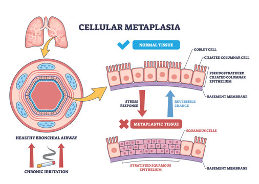 Cellular metaplasia illustrated, airway epithelium shifts from ciliated columnar to stratified squamous under stress, lungs, cilia, squamous cells highlighted. Outline diagram