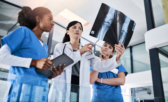 Women, doctor and nurse for xray, discussion and healthcare or knee treatment in hospital. Medical people, surgery advice or planning with radiology, consultation or bone marrow transplant in clinic