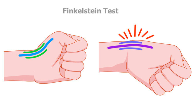 Finkelstein test. Used to test for De Quervain's tenosynovitis of the wrist. make a fist around the thumb. Illustration vector