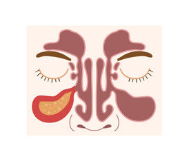 Sinusitis healthy and inflamed nasal sinuses. Human anatomy scientific illustration.