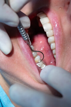 Close-up of dentist removing excess dental cement after crown placement. Precision work during final stage of dental crown cementation and restorative dentistry.