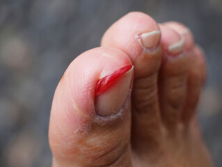 Close up of a red painted toenail with a cut on the toe image