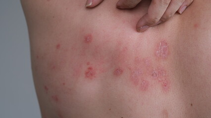 Fototapeta premium A man with his Psoriasis on his back.