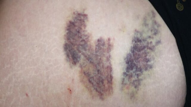 There are bruises on the man's buttock from numerous injections. Hematomas on the skin from drug injections