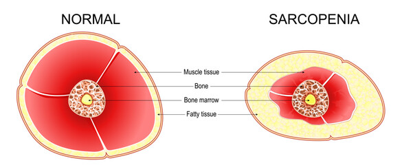 Sarcopenia. Age-related muscle atrophy. 