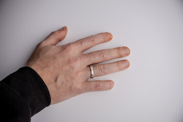 The right hand of an adult person with a scar and missing part of the little finger