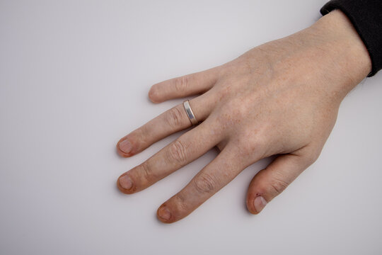 The right hand of an adult person with a scar and missing part of the little finger