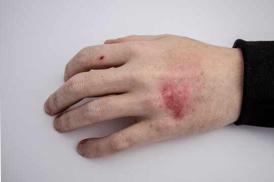 Close-up of a hand with a red, inflamed skin lesion or burn