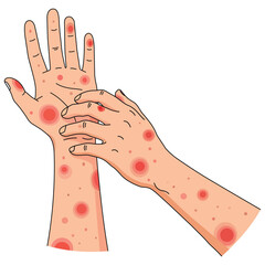 Skin Irritation and Redness: An illustration of a hand exhibiting redness, skin irritation, and the act of scratching. Depicting discomfort and skin issues.