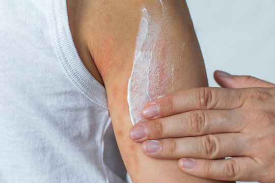 Close-up of a hand applying white cream to a child's irritated arm skin, visible redness and dryness, concept of skin care, atopic dermatitis, eczema, allergy or irritation treatment at home