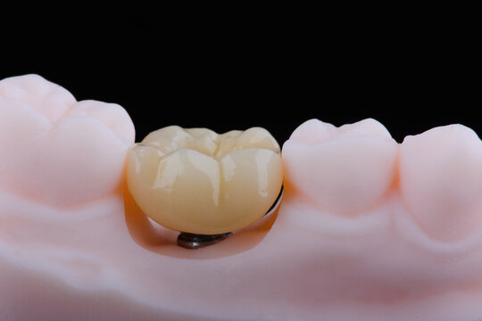 Two dental crown of molar made of zirconium on titanium abutments for fixation to implant