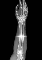X-Ray of Human Arm - Medical Imaging and Skeletal Structure.