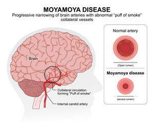 Moyamoya Disease Medical Flashcard Illustration