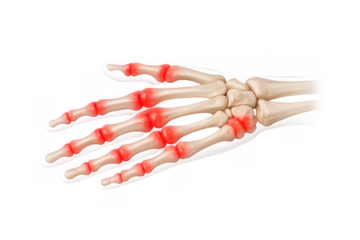 Human hand skeleton with painful arthritis symptoms, showing inflamed red joints, a concept for medical conditions and healthcare