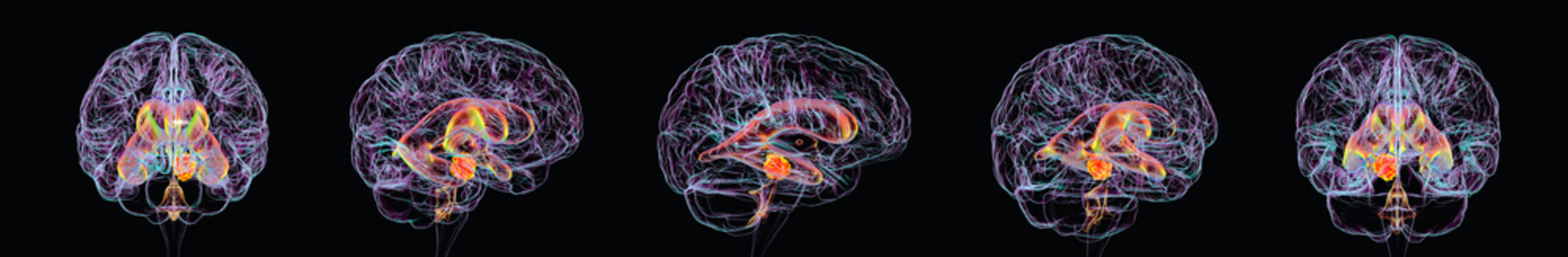 Enlarged lateral and third ventricles with a tumour obstructing CSF flow, seen from multiple anatomical views, 3D illustration.