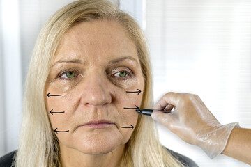 Wrinkled Mature woman before face lift surgery. Marked face for plastic surgery