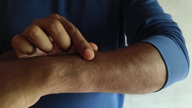 Closeup of hypertrichosis patient arm or hand skin with excessive hair growth. Hairy male body long hair removal waxing or laser treatment concept.