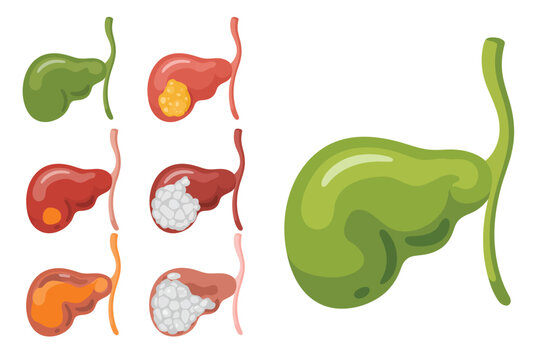 Gallbladder inflammation and gallstone formation stages