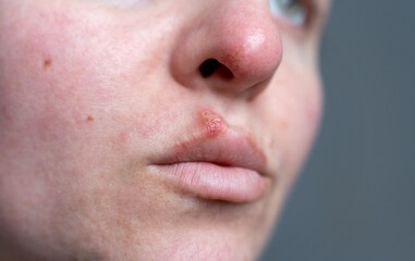 Fototapeta premium Detail of Lips with Herpes Simplex and Redness Around Nose