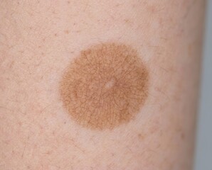 Fototapeta premium Close-up view of a skin mole on a human arm highlighting potential melanoma concerns