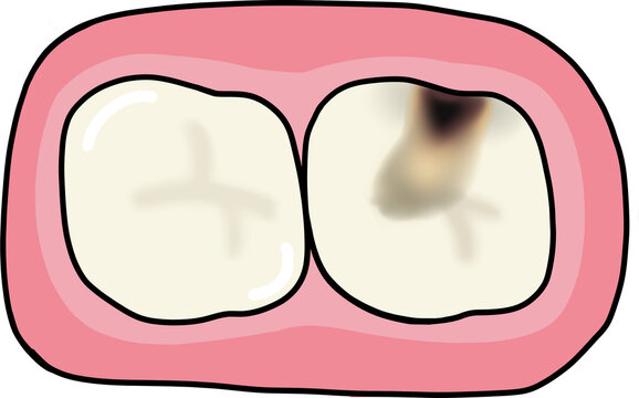 치아 충치치료