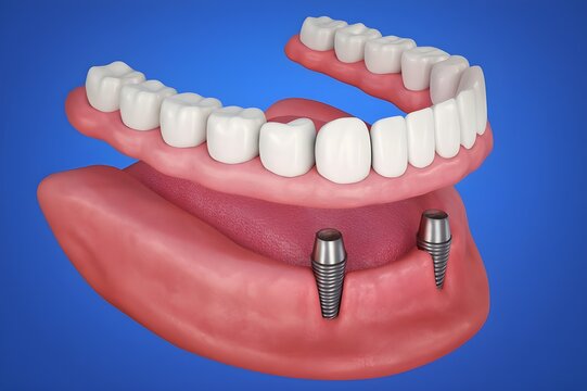 3D Rendering of Removable Overdenture Supported by Two Dental Implants