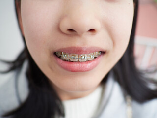 歯の矯正の子供の笑顔
