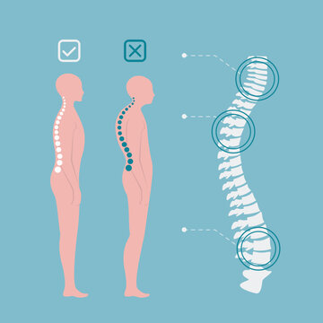 Educational poster with different types of scoliosis. Hyperkyphosis, osteogenesis.Disorders of musculoskeletal system. Example of scoliosis of varying degrees. Spinal curvature