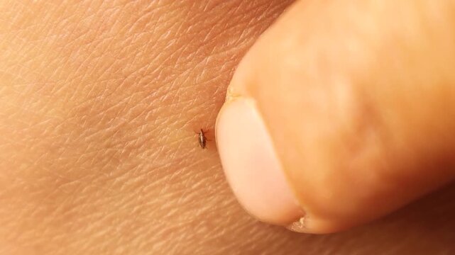 Macro stubborn flea biting human skin and sucking blood, refusing to detach when pushed by a finger. Powerful visual for zoonotic diseases, flea-borne infections, parasitology, dermatology and health.