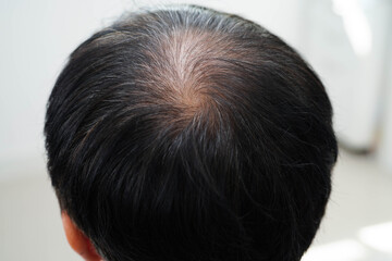 Bald head in man, hair loss treatment health problem.