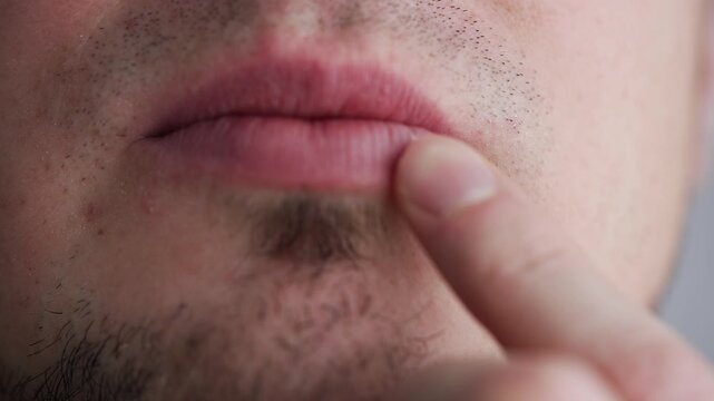 Close-up view of an unshaven man applying topical healing cream to a painful herpes cold sore on his lip, a common viral infection treated with ointment for relief and recovery