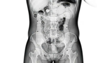 Annotated abdominal Xray featuring detailed markings of airfluid interfaces and bowel loops illustrating key diagnostic signs of intestinal obstruction on a white backdrop.