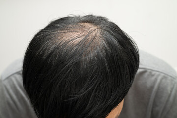 Bald head in man, hair loss treatment health problem.