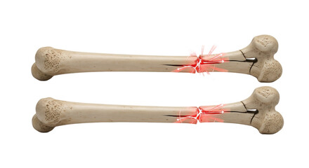 three hyper-detailed 3d anatomical models of a long bone sequentially displaying healthy bone, transverse, and oblique fractures, highlighted by glowing red graphics on a transparent background,