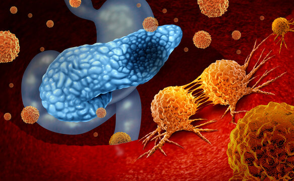 Pancreatic cancer anatomy concept and Pancreas malignant tumor symbol as a digestive gland body part with a microscopic magnification of malignant tumor cells dividing and spreading as a carcinoma dia