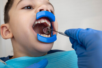 Child dental checkup with mouth retractor. Pediatric dentistry concept