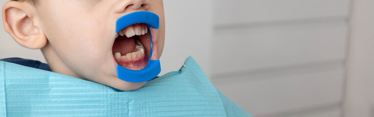 Child dental checkup with mouth retractor. Pediatric dentistry concept